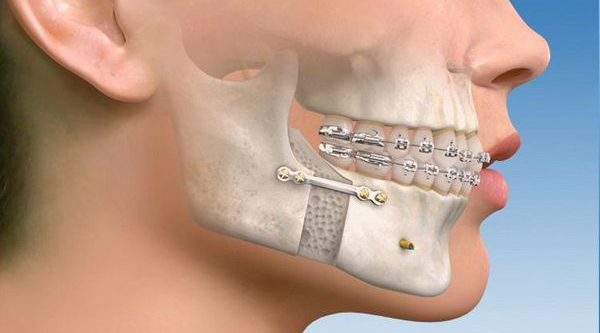Maxillofacial Surgery Maxillofacial Surgery