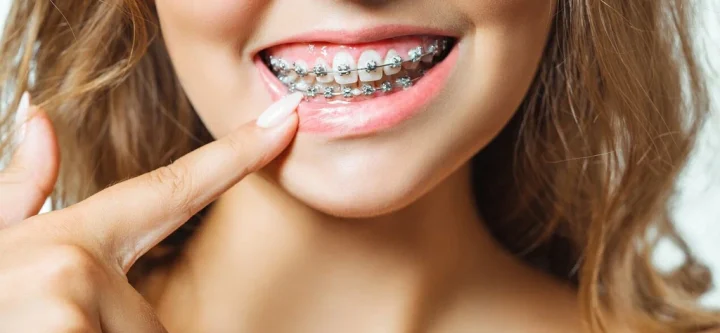 Orthodontic Treatment (Dental Braces) Orthodontic Treatment (Dental Braces)