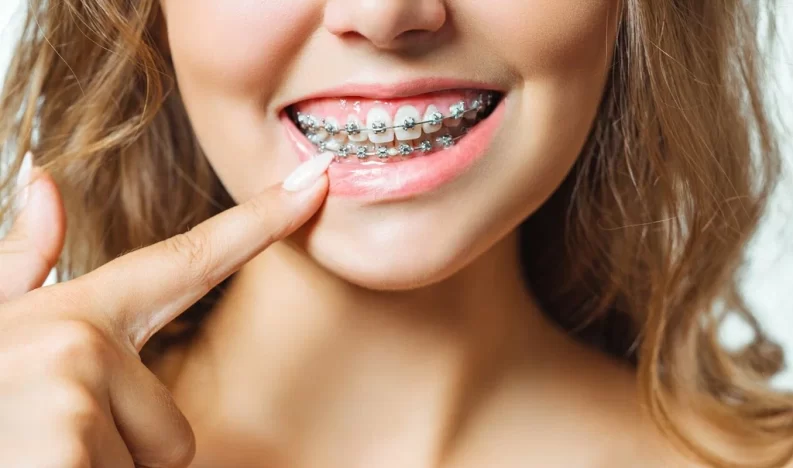 Orthodontic Treatment (Dental Braces) Orthodontic Treatment (Dental Braces)
