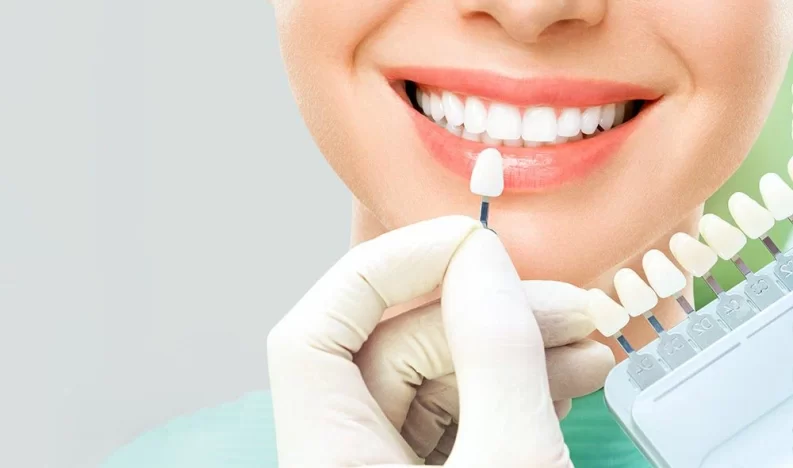 Veneers 1
